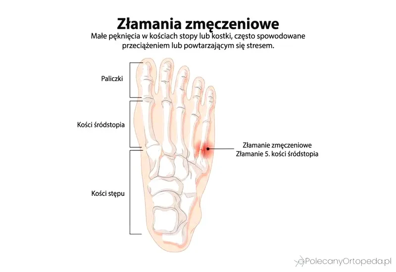 Ćwiczenia po złamaniu kości śródstopia – jak bezpiecznie wrócić do chodzenia